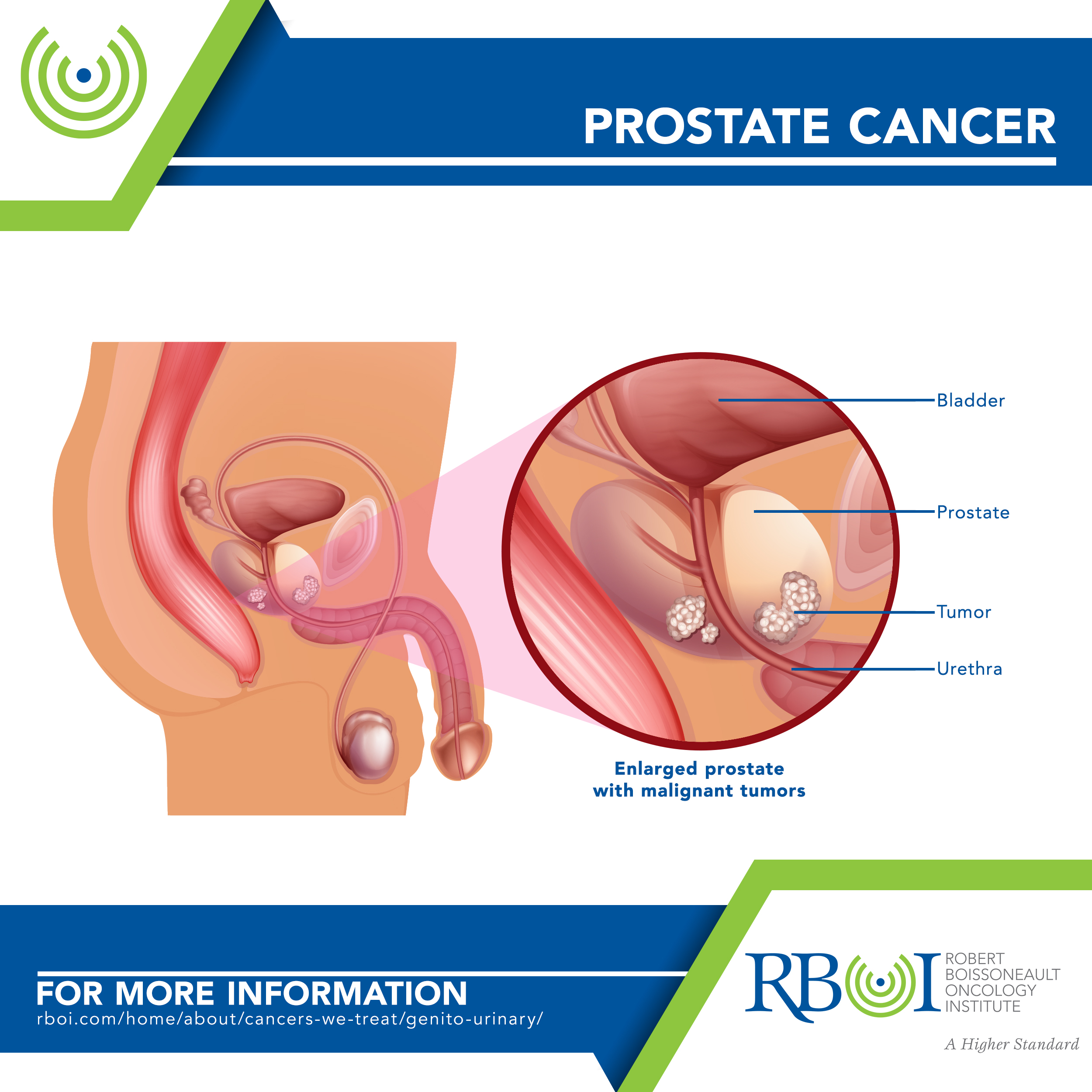 prostate cancer symptoms tests and treatment